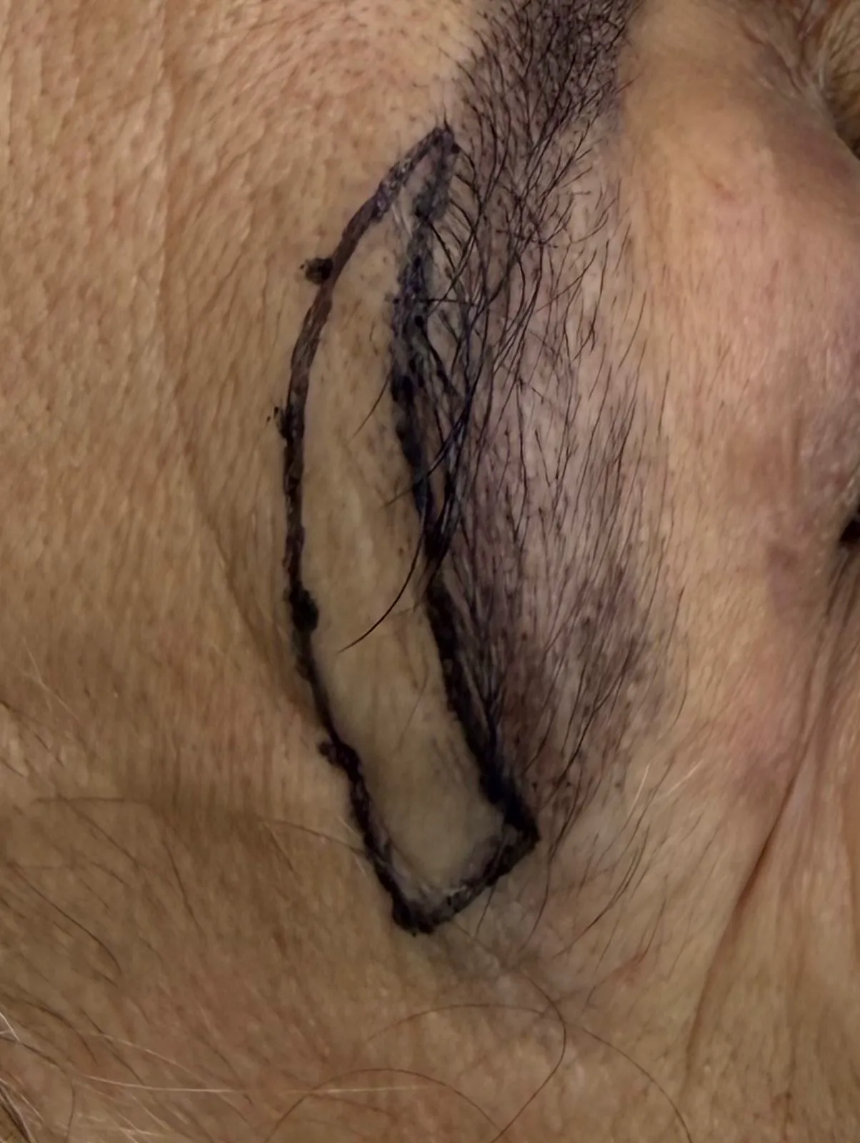 Marcação de blefaroplastia no hands-on do IDC