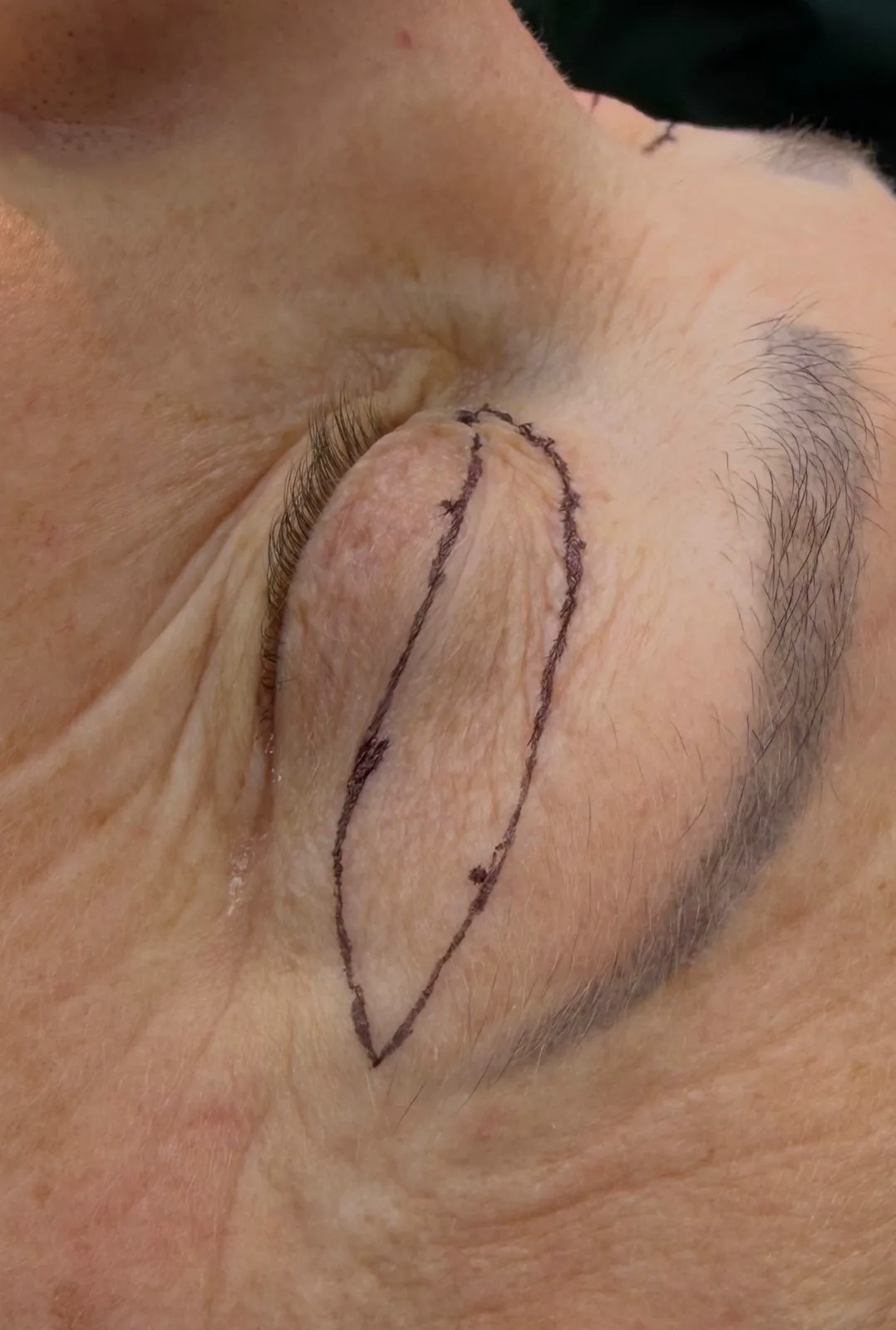 Técnica de blefaroplastia no centro cirúrgico do IDC