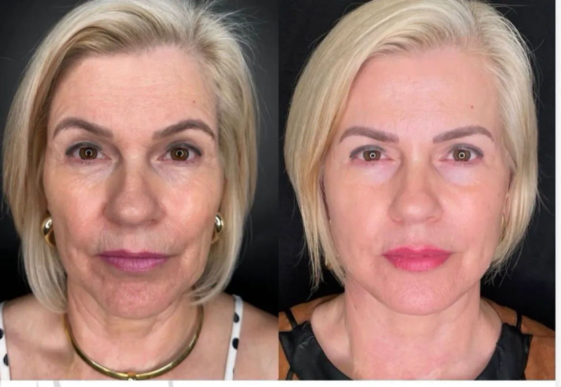 Resultado Face Full Refinement — antes e depois