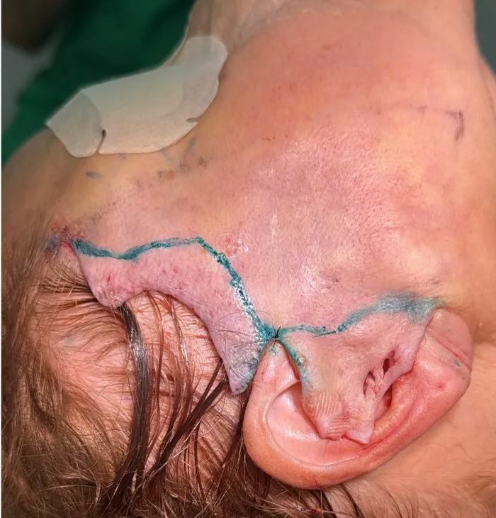 Marcação cirúrgica de lifting facial