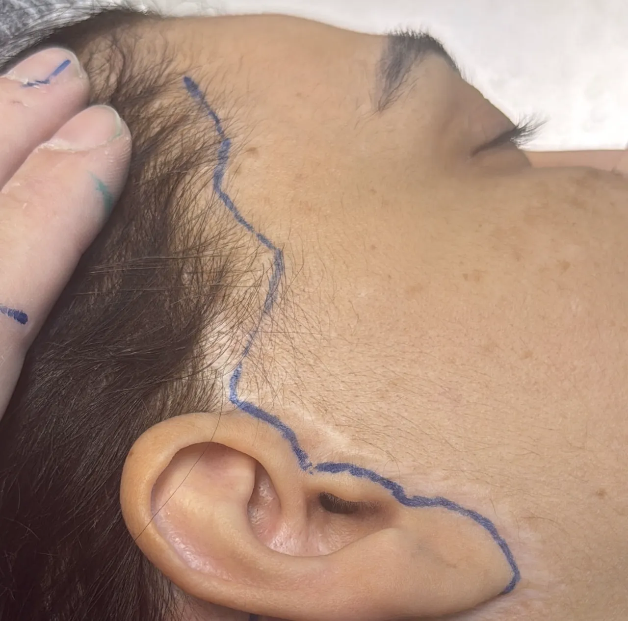 Marcação de lifting facial no hands-on do IDC
