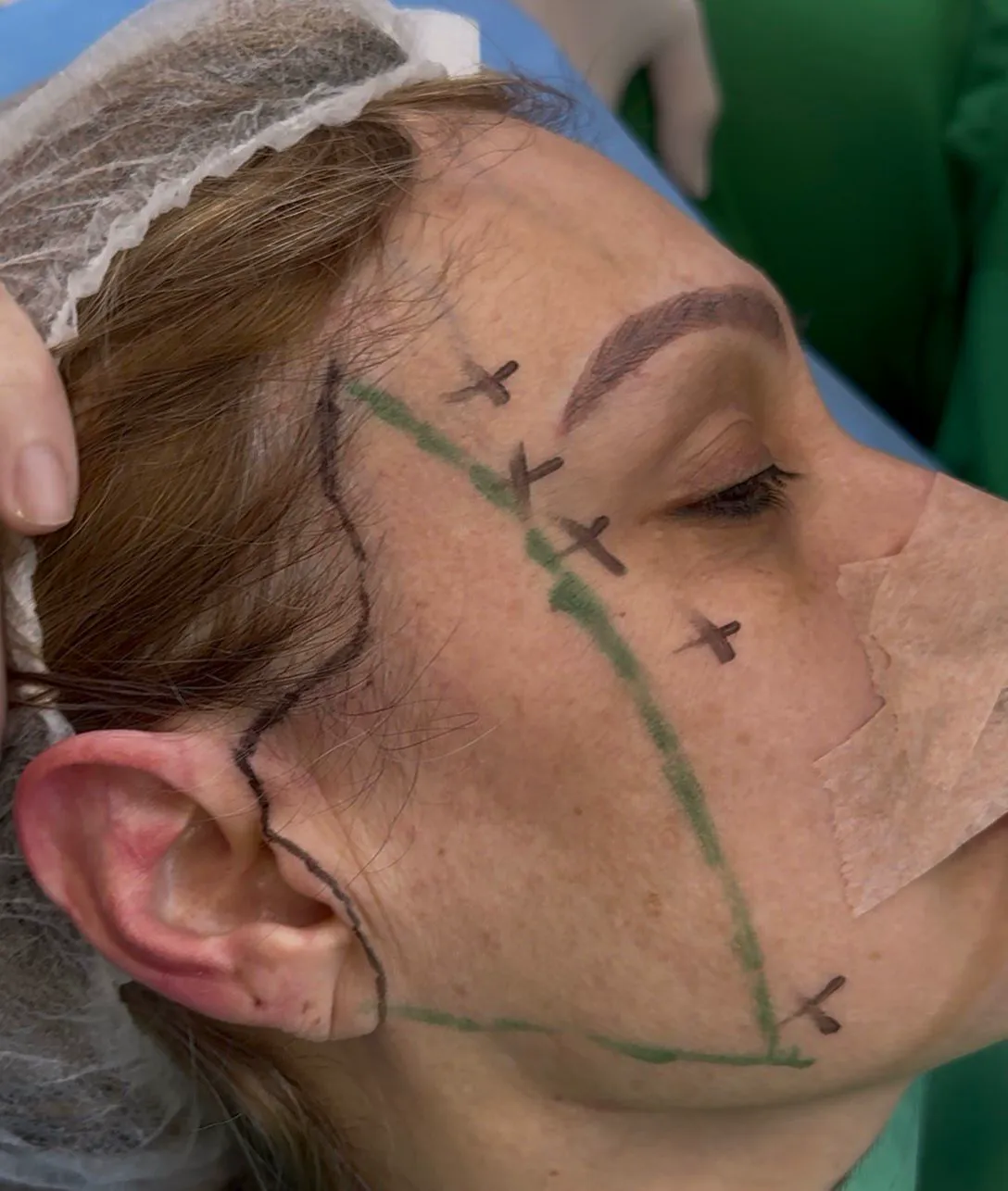Técnica de lifting facial cervical