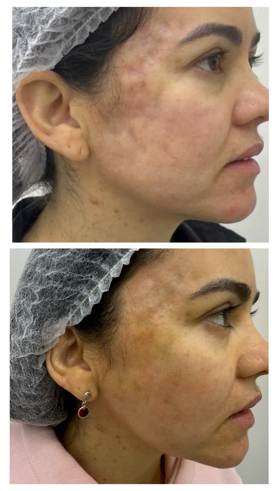 Lipoenxertia facial no hands-on do IDC